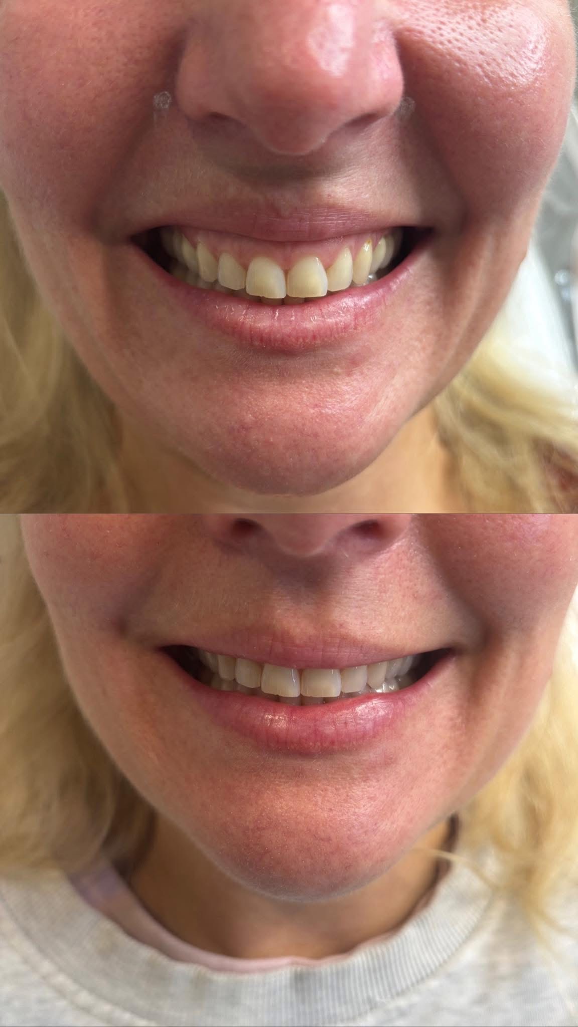 Before and after results
