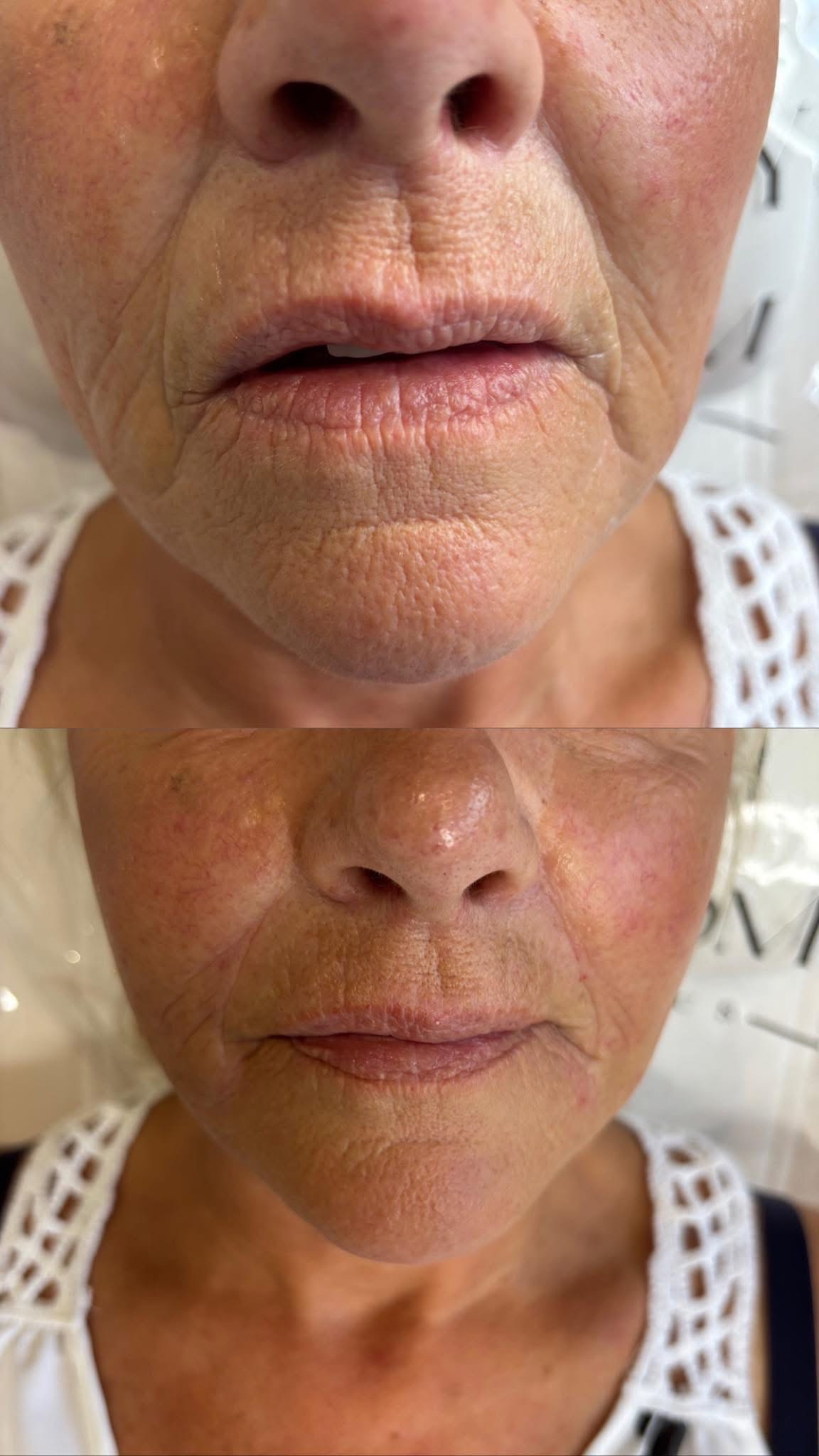 Before and after results