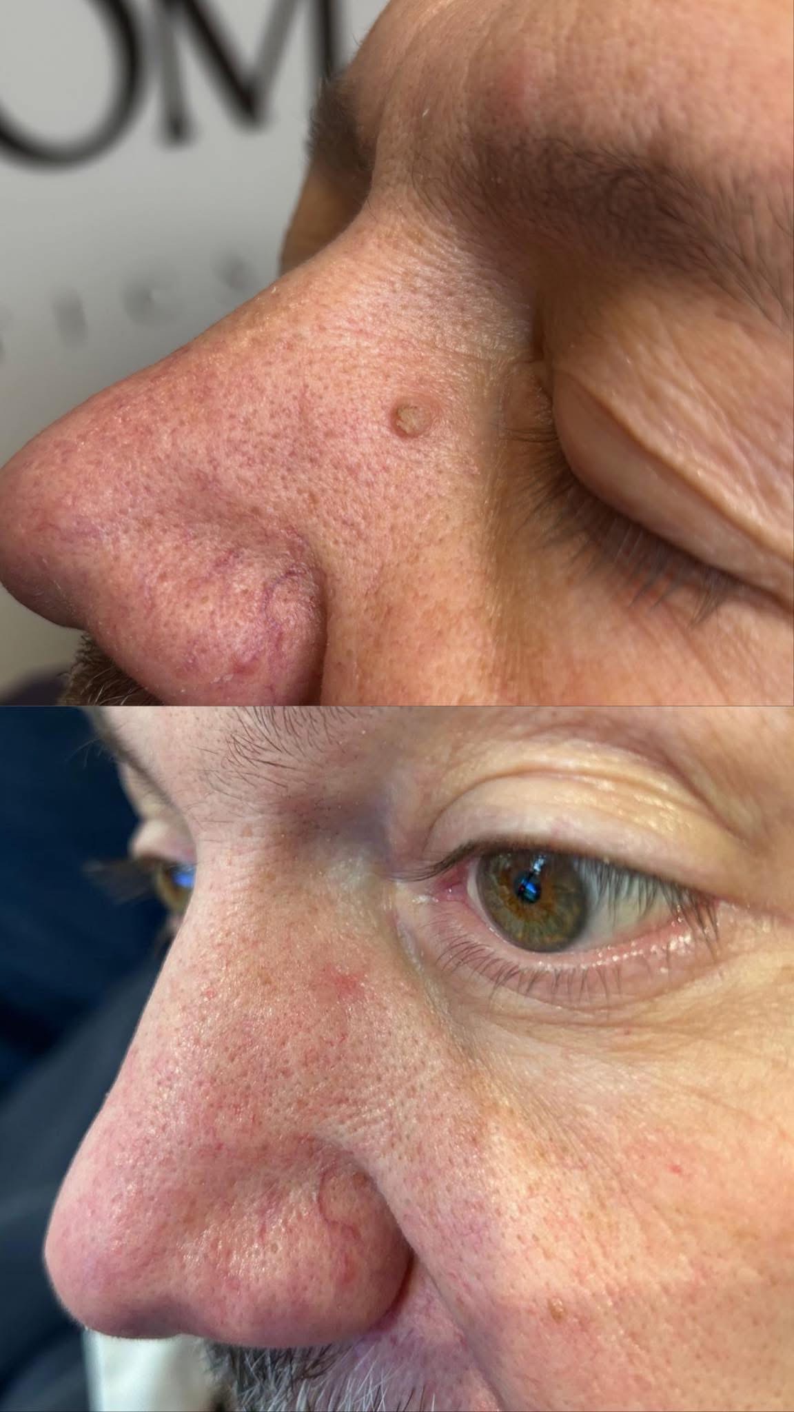 Before and after results
